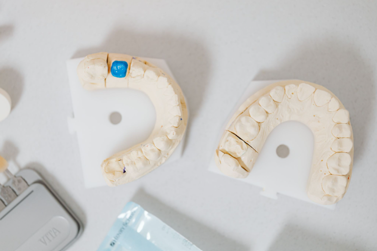 Implants dentaires en plâtres